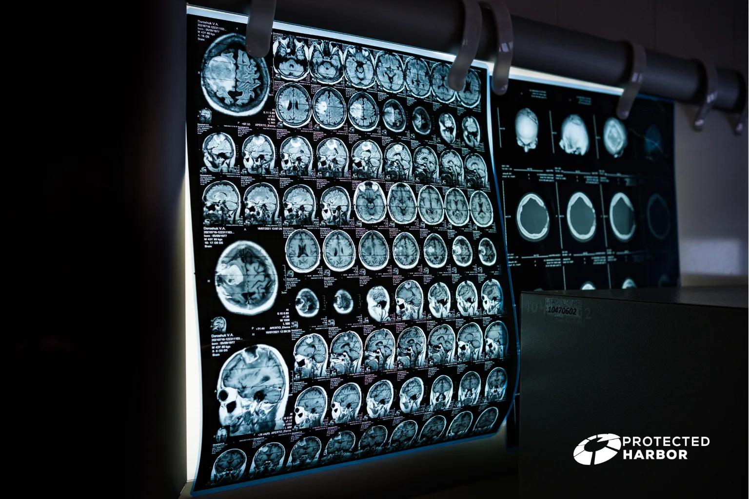 The image shows brain scans displayed on a computer screen